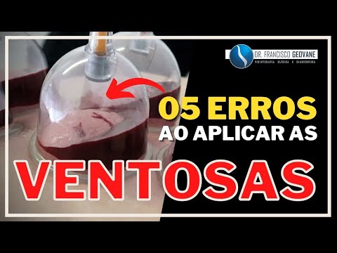 Vídeo: Cupping: As 7 Coisas Que Você Deve Saber Sobre Esta Terapia