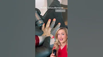 Tattoo Removal Explained 