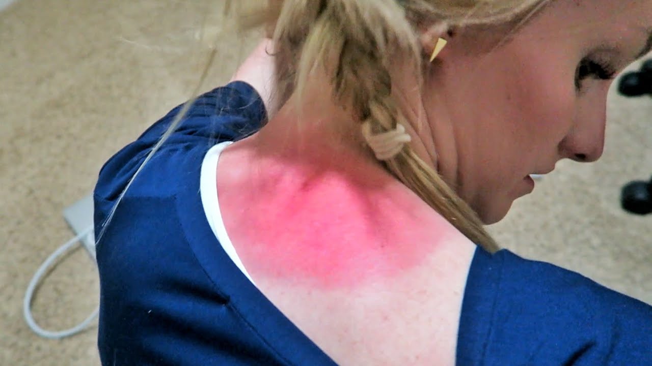 WORLD'S WORST SUNBURN!