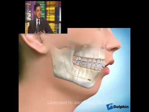 اختناق اثناء النوم بسبب تراجع الفكين