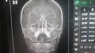 Sinüs Grafisi Radyolojik Anatomi