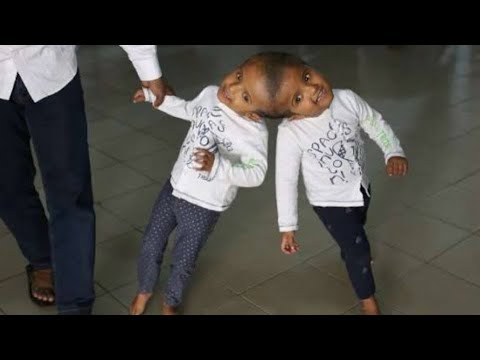 Video: Head-fused Twins Flew From Bangladesh To Hungary For An Operation - Alternative View