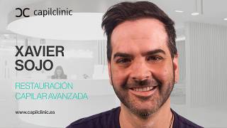 El CAMBIO RADICAL de Xavi a los 2 años de su INJERTO CAPILAR: 4000 UFS