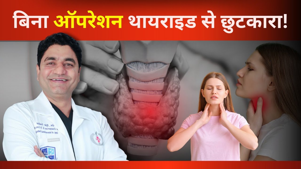 बिना Surgery Thyroid Nodule Treatment Possible है! | RFA & Embolization Explained