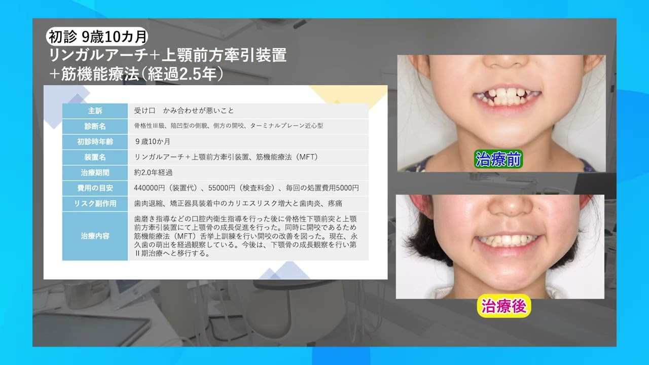 小児矯正 | 木津川市、奈良市の矯正歯科 きづがわ矯正歯科