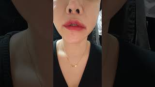 #입꼬리수술 #흉터 #성형수술부작용