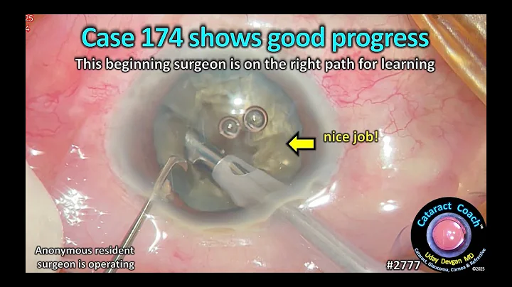 CataractCoach™ 2777: case 174 shows good progress but this is the danger zone!