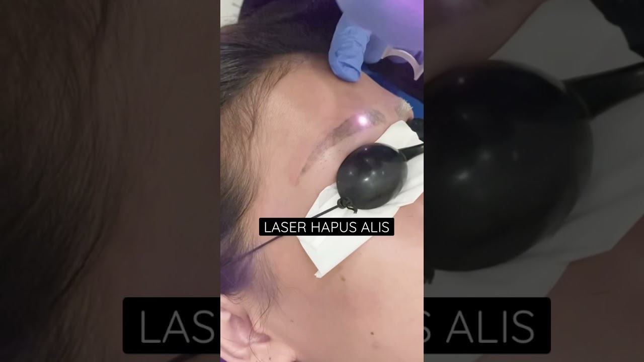 Cara Hapus Sulam Alis Menggunakan Laser 