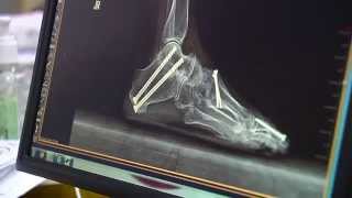 Rheumatoid Arthritis Fixing The Feet