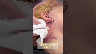 【閲覧注意】スマスフェイスリフトのドレーン抜去 #湘南美容クリニック #女医 #美容 #美容整形 #shorts