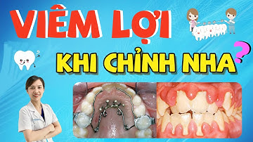 Lật Tẩy Thủ Phạm Gây Viêm Lợi | Chỉnh Nha Có Gây Viêm Lợi Không? Cách Điều Trị Viêm Lợi