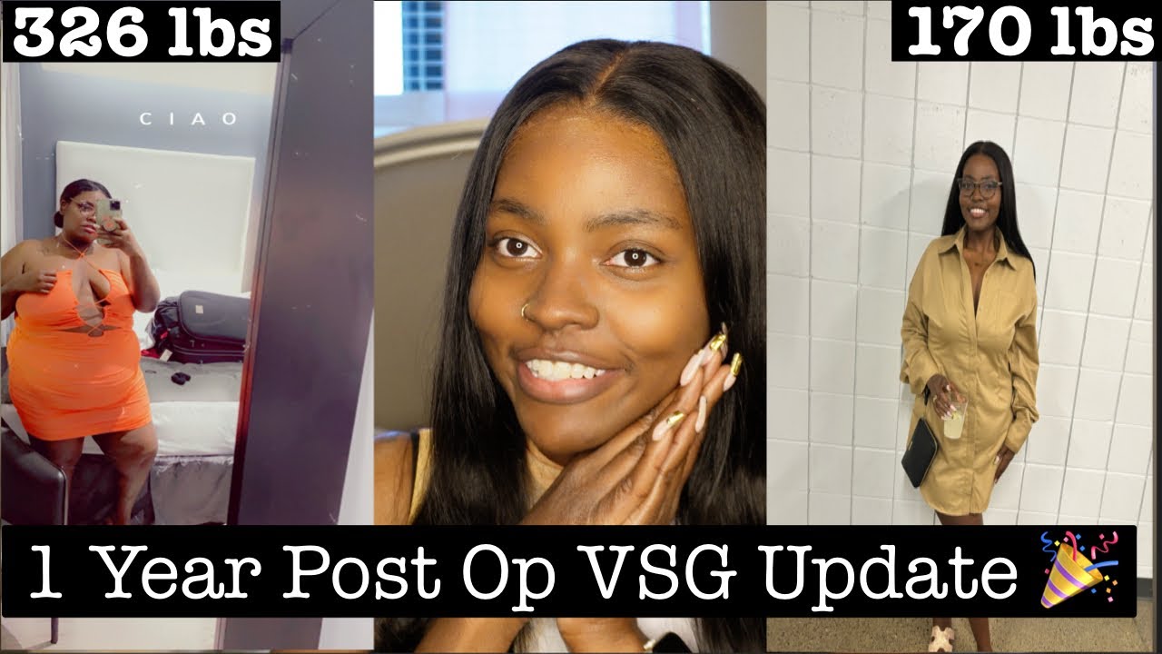 1 Year Post Op VSG Update The Key To Success After VSG Tummy Tuck