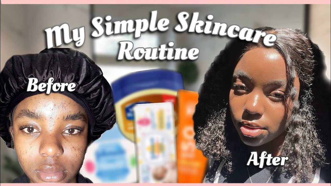 My Affordable Skincare Routine For Acne & Scars | South African YouTuber