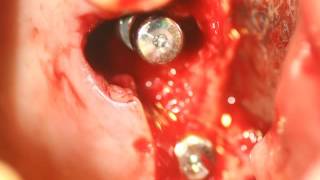 Одномоментная установка имплантов INNO(, 2016-09-14T17:19:17.000Z)