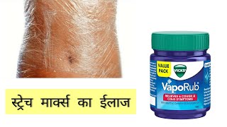 Vicks Vaporub se स्ट्रेच मार्क्स का ईलाज Kaise Kare | Stretch marks in Hindi