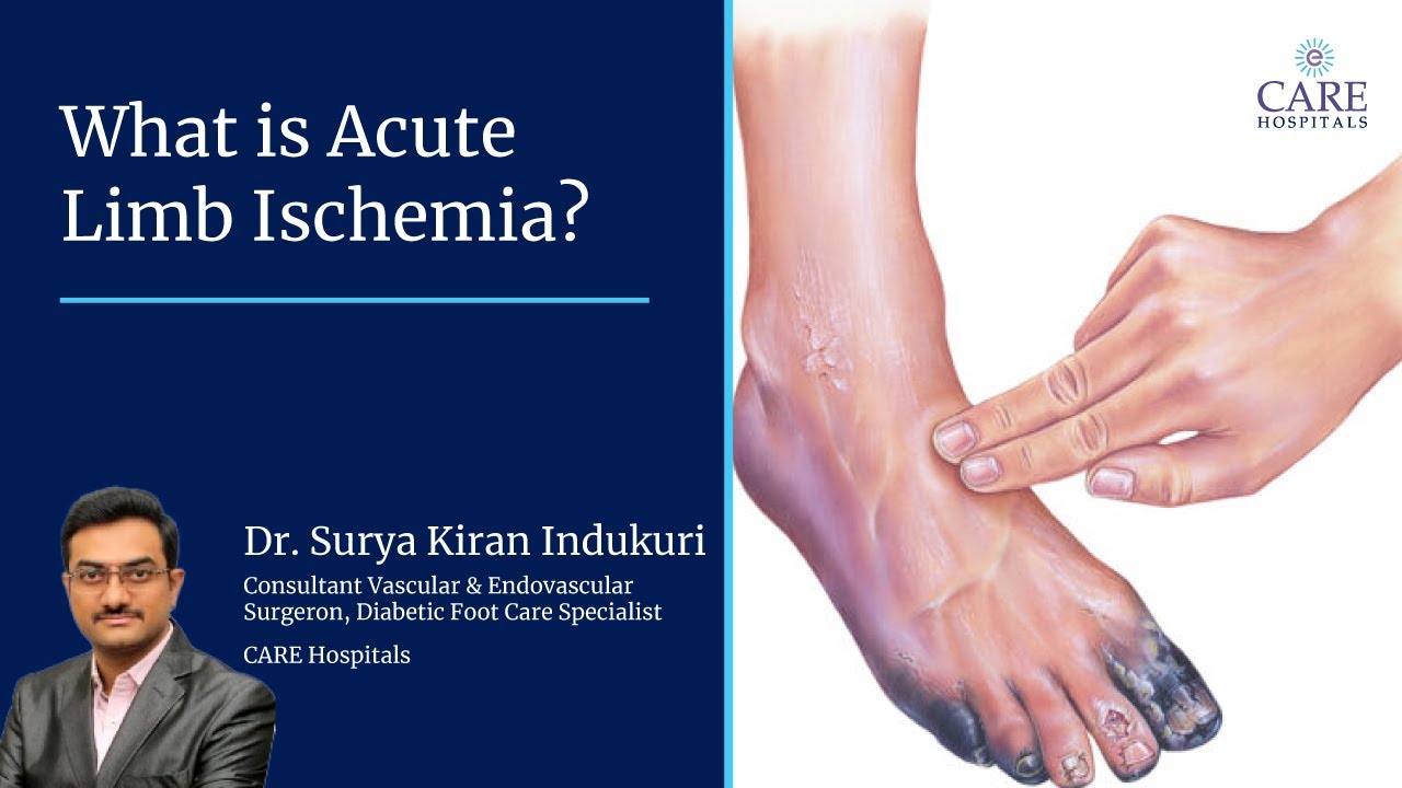What is Acute Limb Ischemia? | Dr. Surya Kiran Indukuri | CARE Hospitals, Banjara Hills, Hyderabad