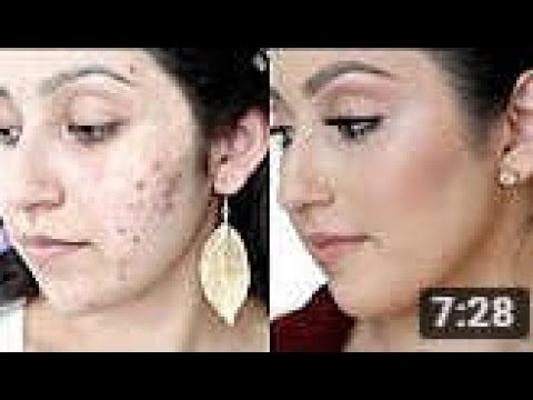 6 وصفات لازالة البقع من الوجه والتخلص من آثار حب الشباب  6 وصفات لازالة البقع من الوجه والتخلص من آثار حب الشباب