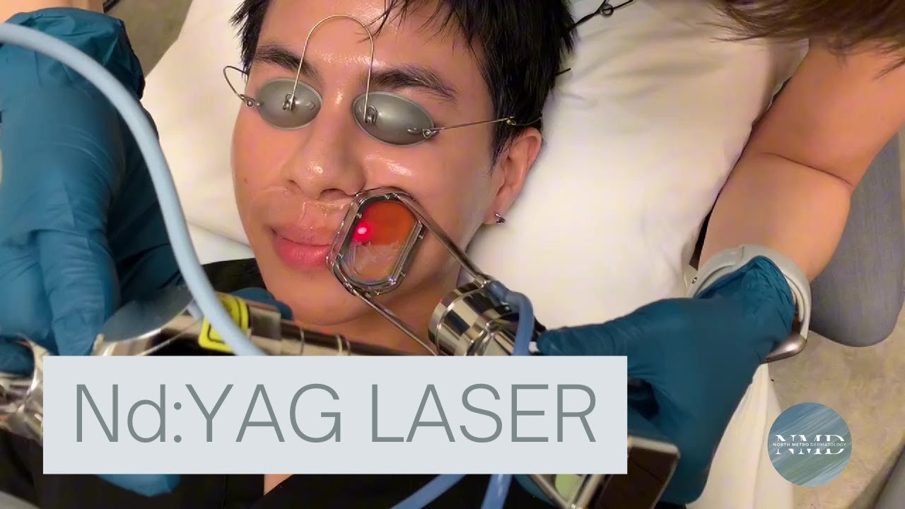 Nd:YAG Laser Treatment