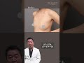 【脂肪豊胸】授乳後のしぼんだバストを復活!