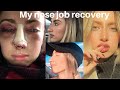 My nose job experience