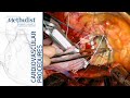 Acute Type-A Aortic Dissection Repair with Bentall Procedure (Ramchandani MD, Spooner MD, Zubair MD)
