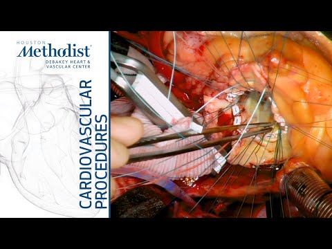 Vidéo: Chirurgie De Remplacement Valvulaire: Types, Procédure Et Récupération
