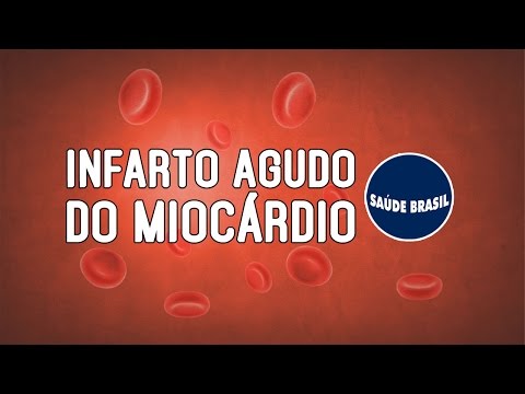 Vídeo: Grandes Arritmias Hospitalares, Morte Arrítmica E Reanimação Após Intervenção Percutânea Primária Bem-sucedida Para Infarto Transmural Agudo: Um Estudo Retrospectivo De Coorte De C