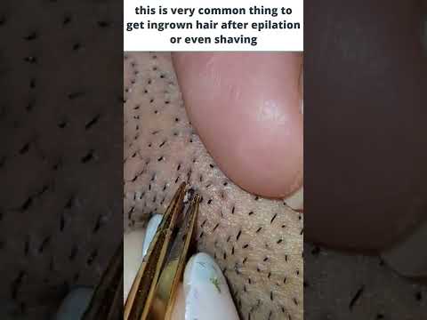 This is very common thing to get ingrown hair after epilation or even after shaving