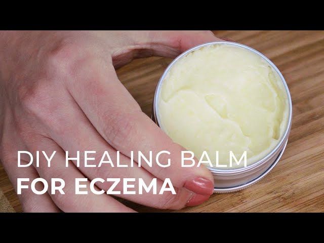Tutorial for making a Natural Healing Cream for Eczema and Psoriasis