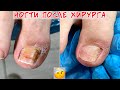 Ногти после хирурга / После частичного удаление вросшего ногтя