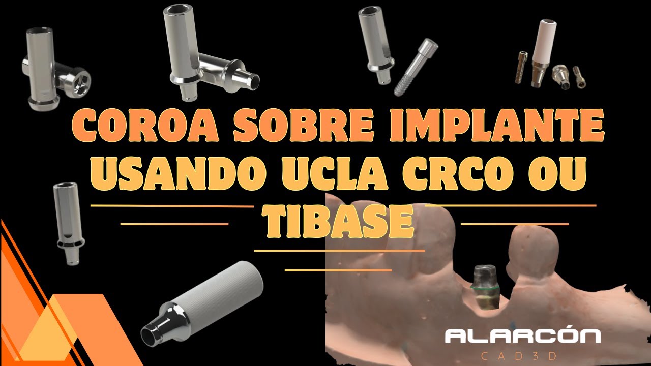 COROA SOBRE IMPLANTE USANDO UCLA  CRCO OU TIBASE #fluxodigital #laboratoriodental #exocad #cad