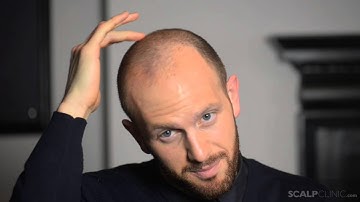 Scalp Micropigmentation at Scalp Clinic - Rob