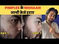 Acne Marks Kaise Hataye Dark spots remove karne ka sahi tareeka