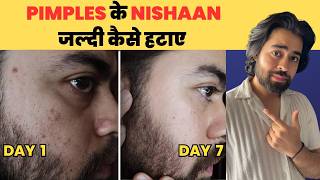 Acne Marks Kaise Hataye Dark spots remove karne ka sahi tareeka