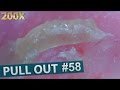 #58 Pull Out Blackheads Close up 200X - Blackheads Removal