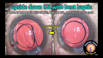 CataractCoach 1152: rescue this upside down IOL with a bent haptic