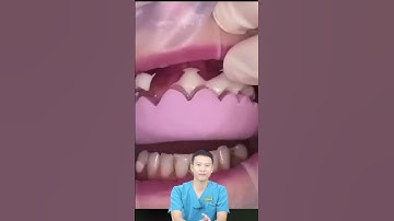 Răng Cửa Thưa Thì Phải Làm Sao?