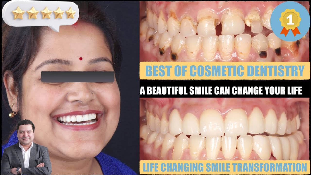 Amazing Smile Makeover in Just 12 hours Best Cosmetic Dental