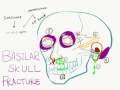 10 Signs and Symptoms Of Basilar Skull Fracture (Basal Skull Fracture)