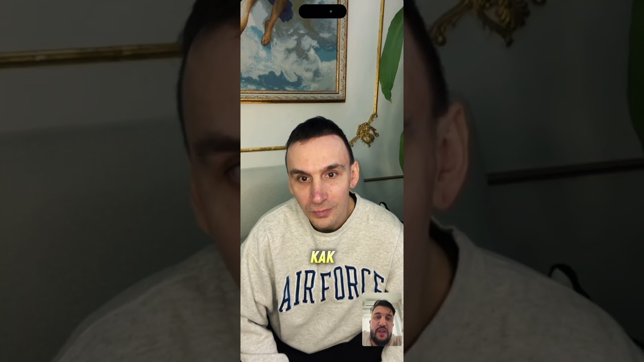 ПЕРЕСАДКА ВОЛОС РЕЗУЛЬТАТ ЧЕРЕЗ 3,5 МЕСЯЦА!!! ДО ПОСЛЕ 