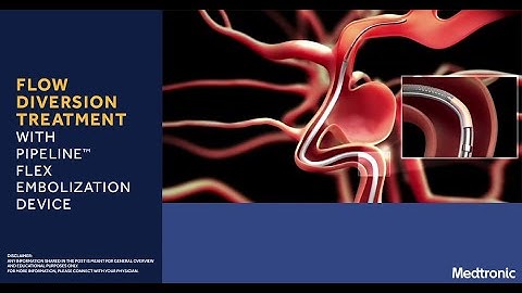 Flow Diversion Treatment with Pipeline Flex Embolization Device | Medtronic India