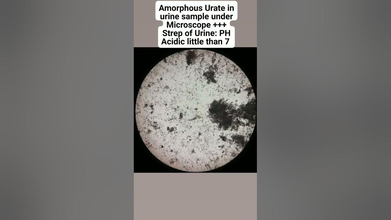 amorphous-urate-in-urine-sample-under-microscope-strep-of-urine-ph