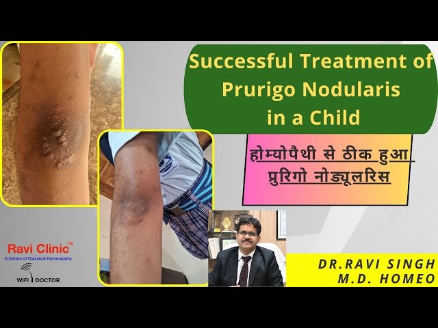 Prurigo Nodularis Signs, symptoms and Homoeopathic Cure Dr ravi Singh