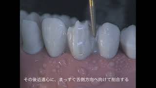 CDTCコース上顎犬歯支台歯形成デモその1:ガイドグルーブの付与