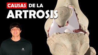 Por Qué Desarrollamos Artrosis En Nuestras Articulaciones
