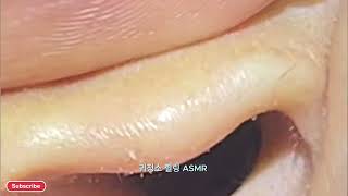 이 소리, 진짜 사람 귀에서 나온 거예요    😳 귀청소 ASMR 리얼 사운드 대공개!