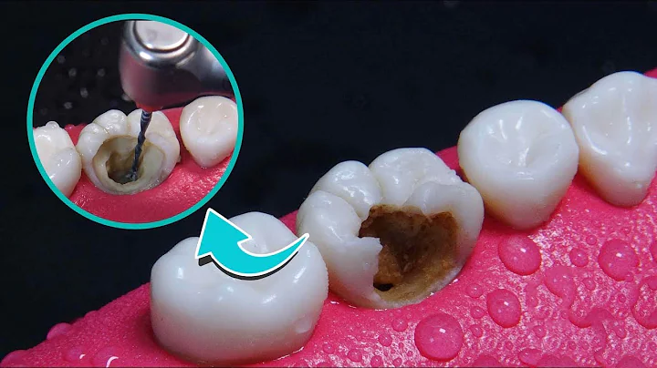 蛀牙是蟲子引起的嗎？用3D模擬全過程，看完你還敢亂吃東西嗎？ - 天天要聞