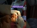 Implant placement #cosmetics #implant #dental #dentalcare #hyderabad #hyderabaddentist #smile