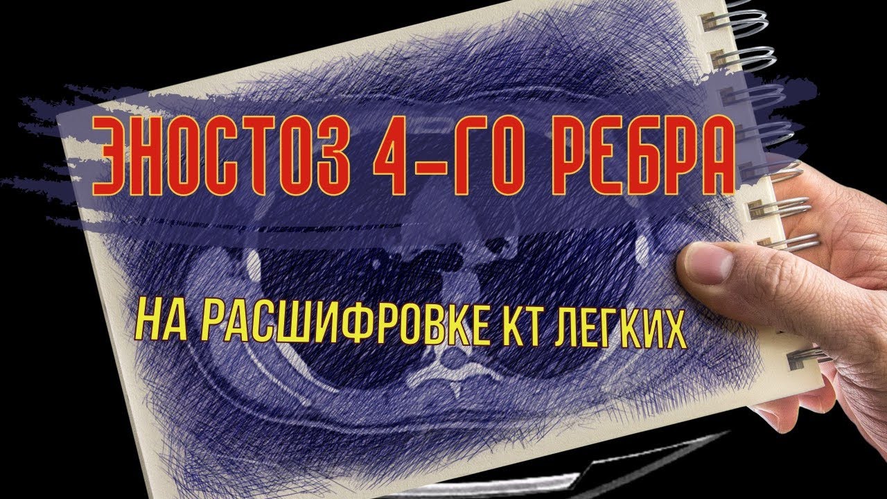 ЭНОСТОЗ ребра (остеосклероз) на КТ легких РАСШИФРОВКЕ (КТ второе мнение)
