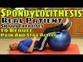 Spondylolithesis- Real Patient Shows Exercises to Reduce Pain & Stay Active